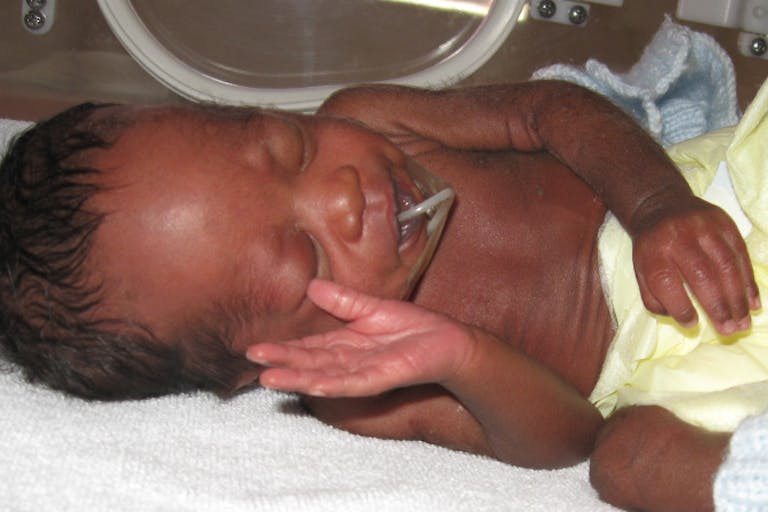 A premature babies served by the International Milk Bank