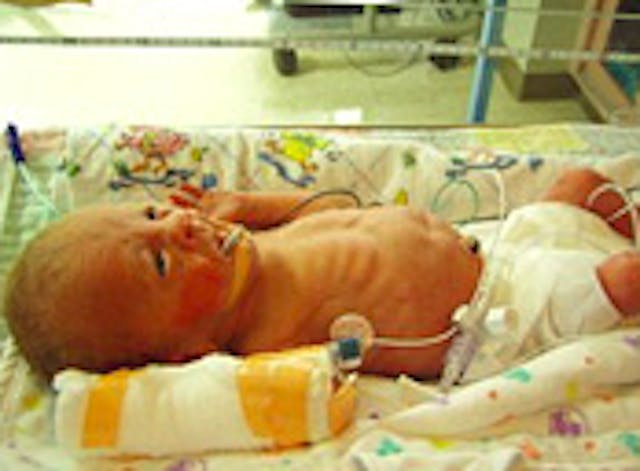 A preemie served by the International Breast Milk Project A preemie served by the International Breast Milk Project