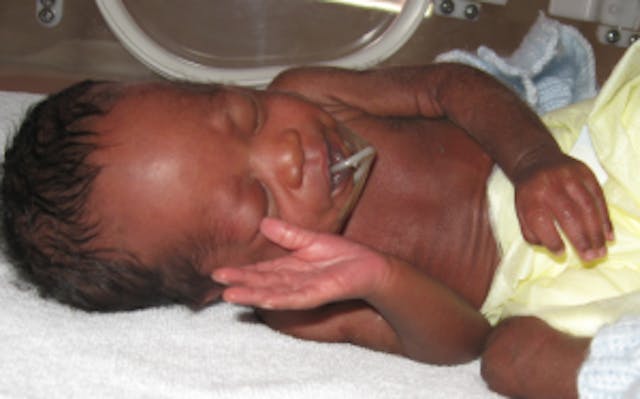 A premature baby served by the International Milk Bank A premature babies served by the International Milk Bank
