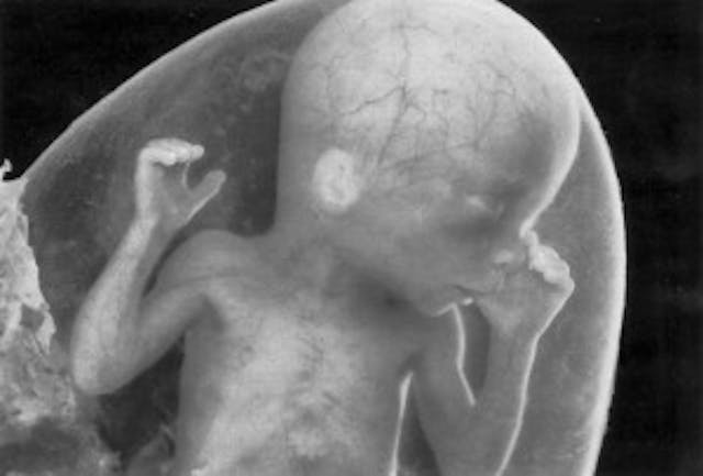 A developing preborn child A developing unborn child