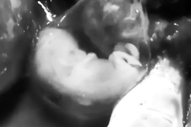 ectopic pregnancy humanity