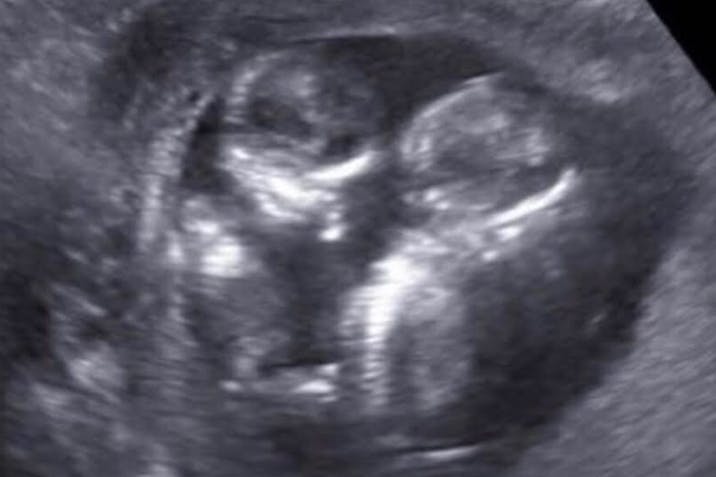 abortion