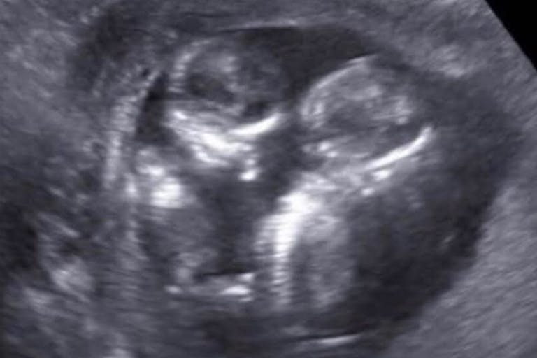 abortion