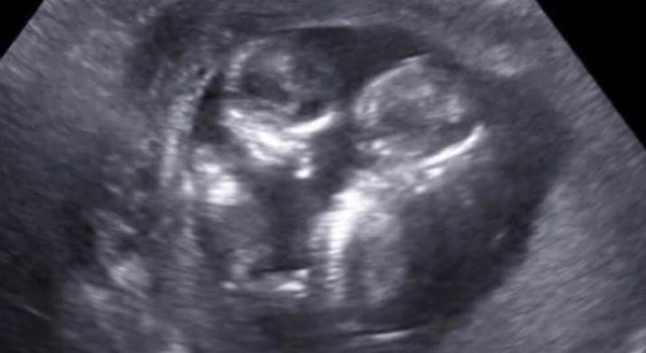 abortion