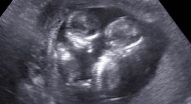 abortion