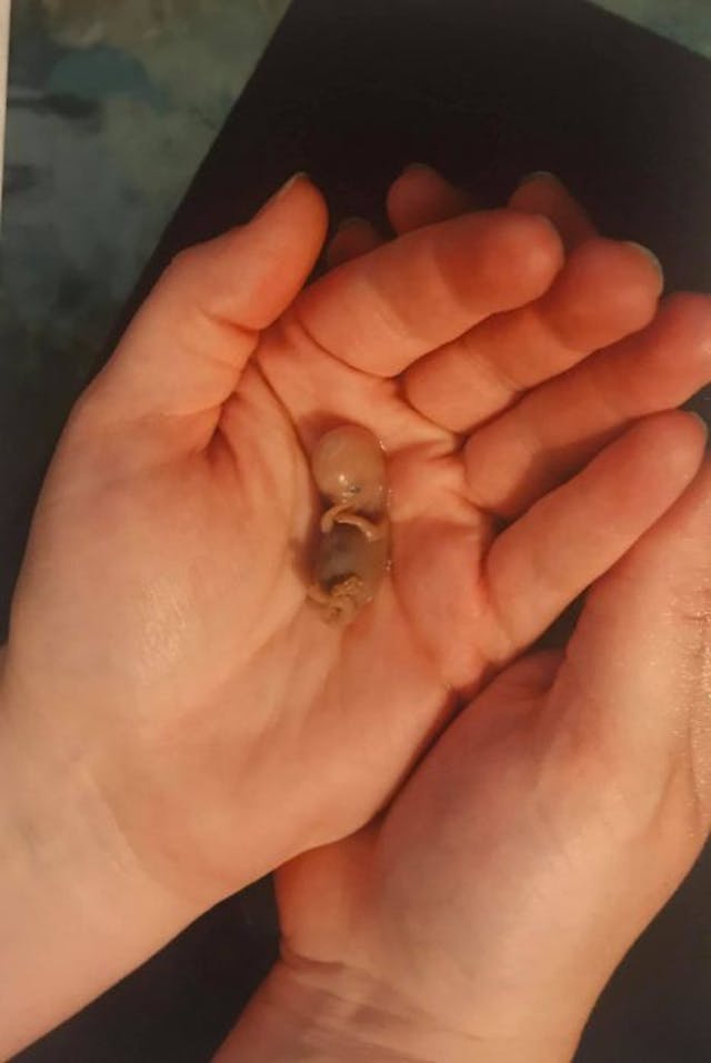 Via Facebook (Brandy Hogue Plunkett) Woman shares images of miscarried baby to show humanity of life at 10 weeks image