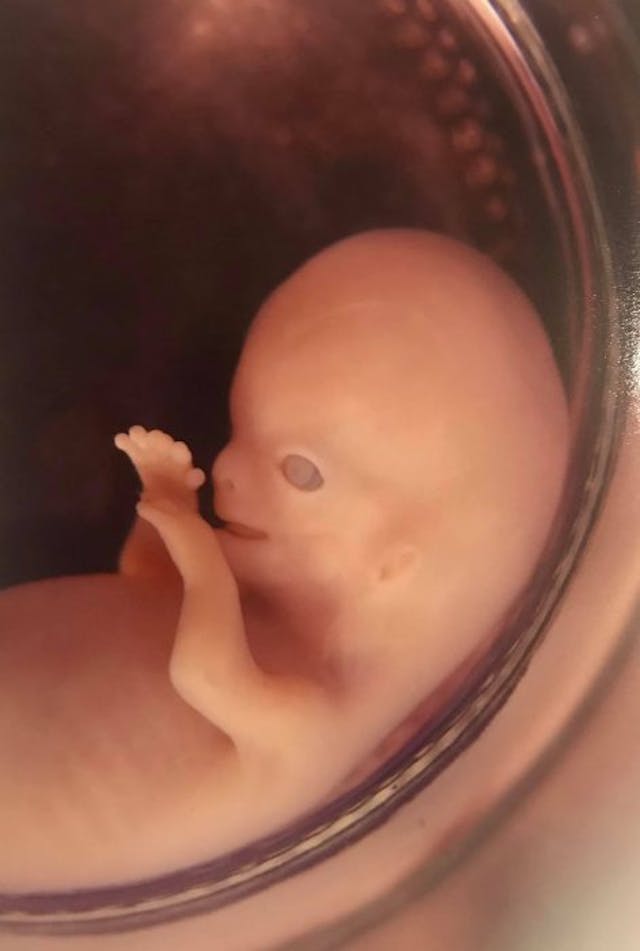 Via Facebook (Brandy Hogue Plunkett) Woman shares images of miscarried baby to show humanity of life at 10 weeks image