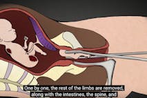 late-term abortion, D&E abortion, Go to www.AbortionProcedures.com for facts on abortion, dismemberment abortion