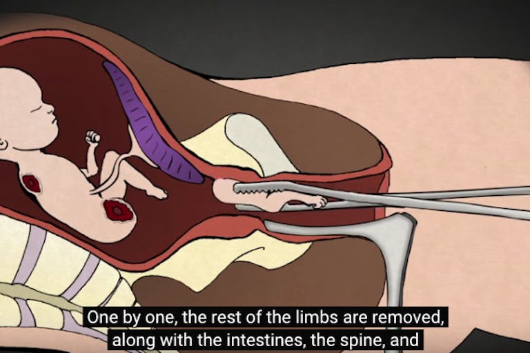 late-term abortion, D&E abortion, Go to www.AbortionProcedures.com for facts on abortion, dismemberment abortion