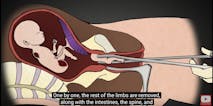 late-term abortion, D&E abortion, Go to www.AbortionProcedures.com for facts on abortion, dismemberment abortion