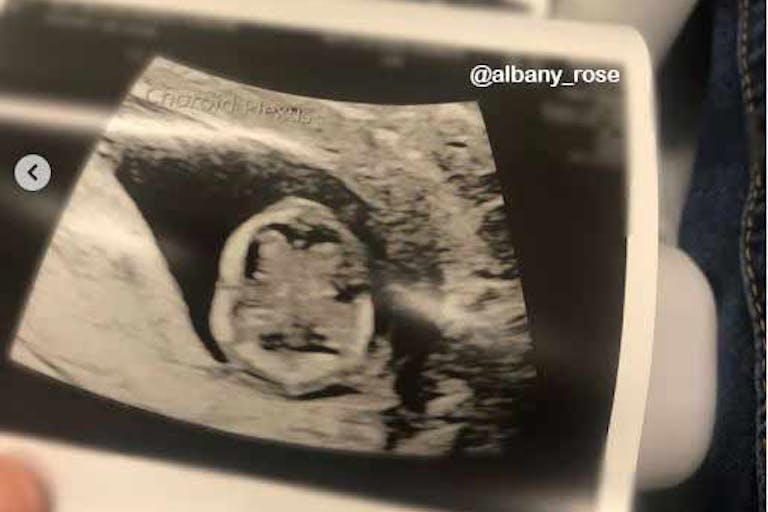 instagram-albany-rose-12-week-brain