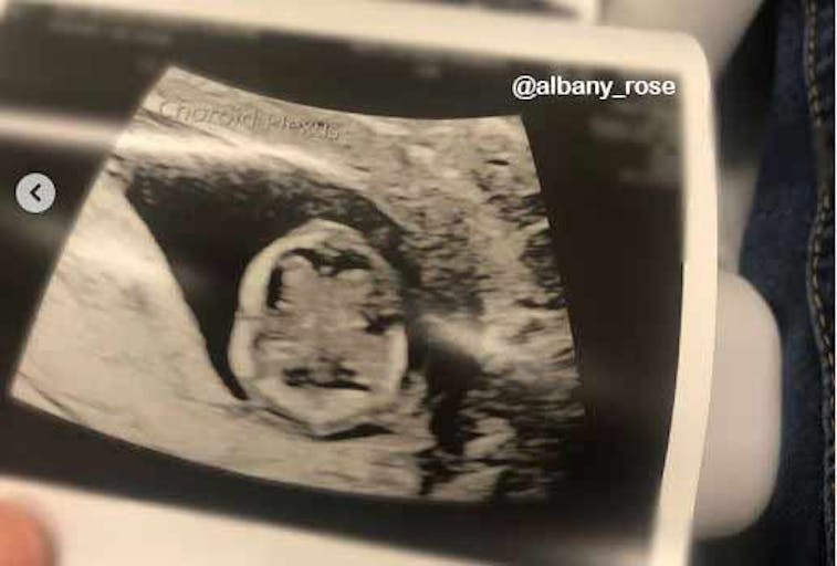 instagram-albany-rose-12-week-brain