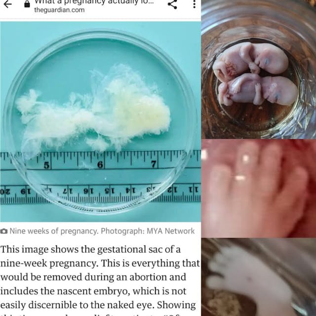Mom shares images of 10-week miscarried twins, refuting Guardian’s ‘pregnancy tissue’ farce image