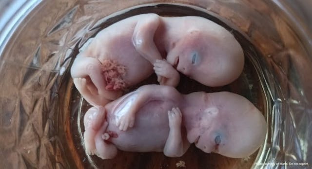 Maria’s twin daughters, Amanda and Jireh, miscarried at 10 weeks and one day. Photo courtesy of Maria. Do not reprint. Mom shares images of 10-week miscarried twins, refuting Guardian’s ‘pregnancy tissue’ farce image