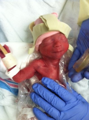 preemie, premature