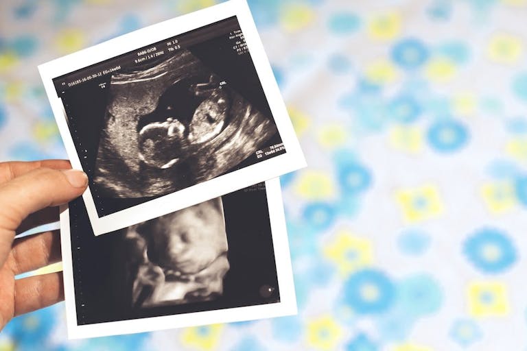 ultrasound, aborted, late-term, abortions