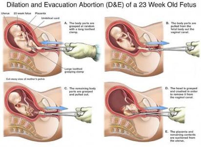 D & E diagram, abortion