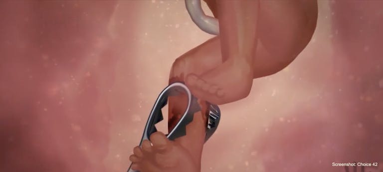 choice 42 screenshot procedure