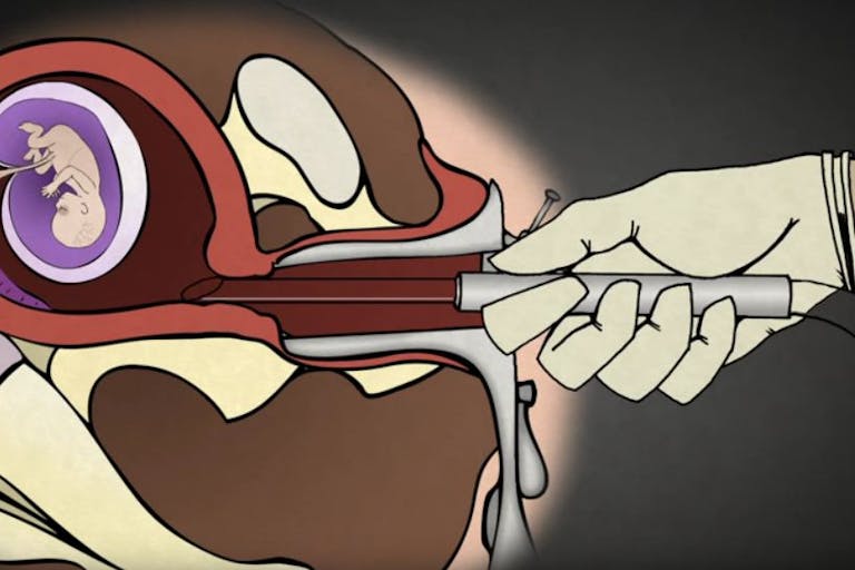 Vacuum aspiration or suction abortion – 1st Trimester Surgical Abortion: Aspiration (Suction) D&C (Abortionprocedures.com) 1st Trimester Surgical Abortion: Aspiration (Suction) D & C (Abortionprocedures.com)