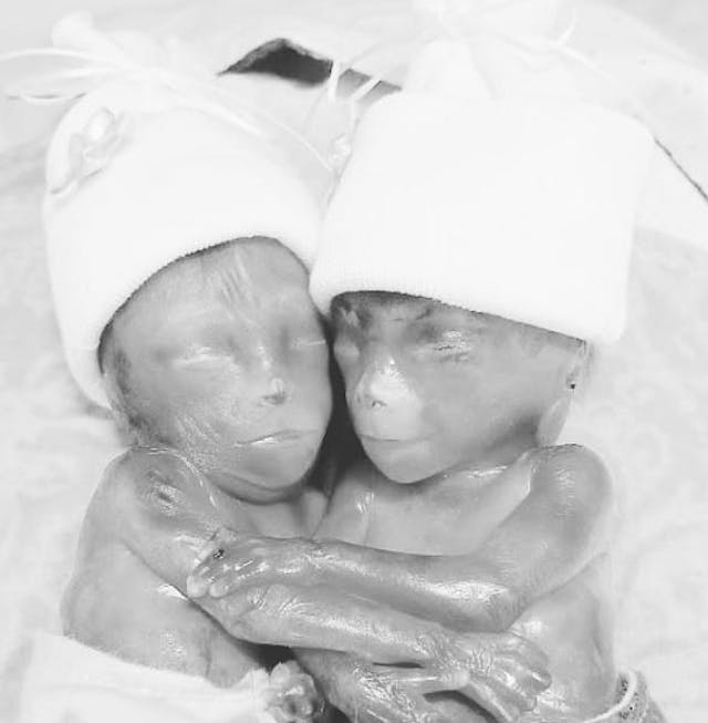 Amanda Powell’s premature identical twins Walker and Clark born too soon to survive outside the womb. Amanda Powell's premature identical twins Walker and Clark born too soon to survive outside the womb.