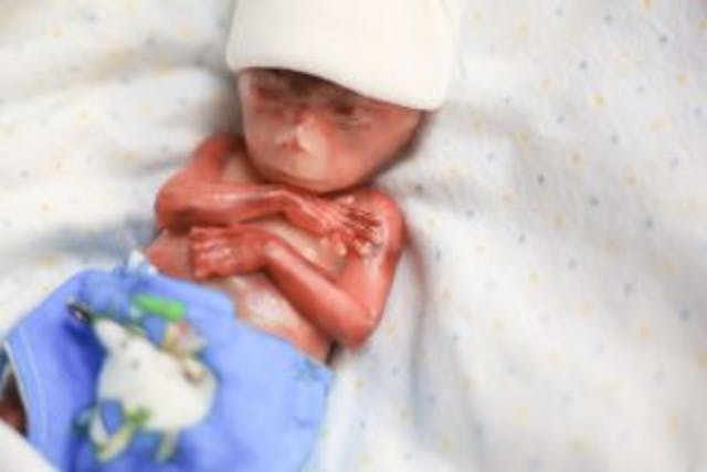 Mother shares powerful photos of identical twins miscarried at 19 weeks image