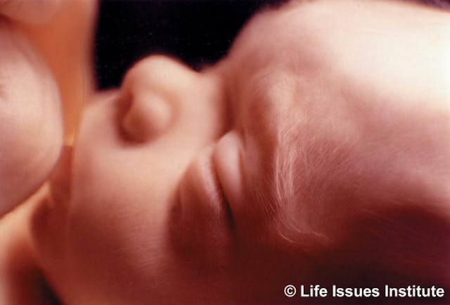 A 20-week-old unborn baby. abortions,abortion, late-term, aborted, baby olivia