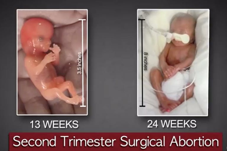 abortion 20 weeks