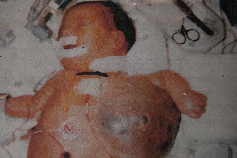 Abraham at birth cystic hygroma