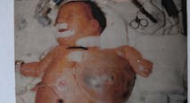 Abraham at birth cystic hygroma