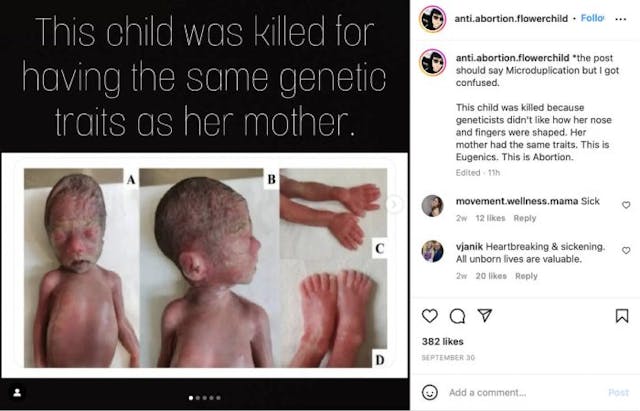 Study reveals heartbreaking images of baby girl aborted at 26 weeks image