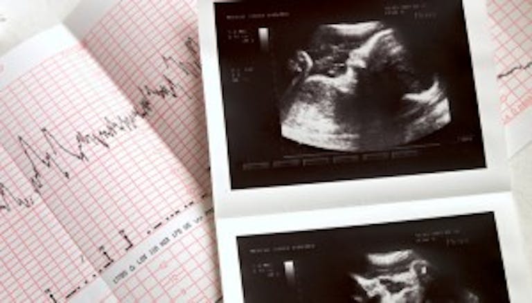 sonogram ultrasound