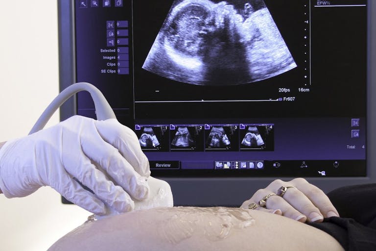 congenital heart defects