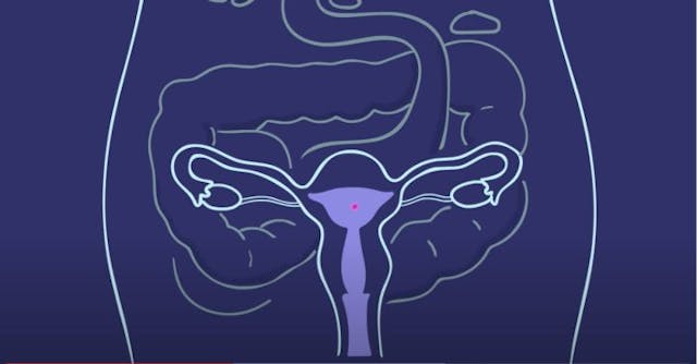 Planned Parenthood sex-ed partner promotes abortion pill to 10-year-olds image