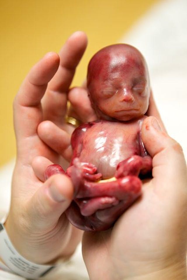 Walter Joshua Fretz, who lived for 19 weeks in the womb. Credit: Lexi Fretz & F2 Photography Walter Joshua Fretz who lived 19 weeks.