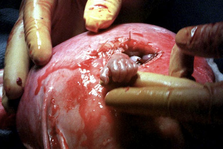 “Hand of Hope” by Michael Clancy Pushed into abortion, 24-week-old Baby Royer’s parents chose fetal surgery instead image
