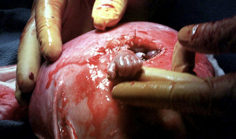 Pushed into abortion, 24-week-old Baby Royer’s parents chose fetal surgery instead image