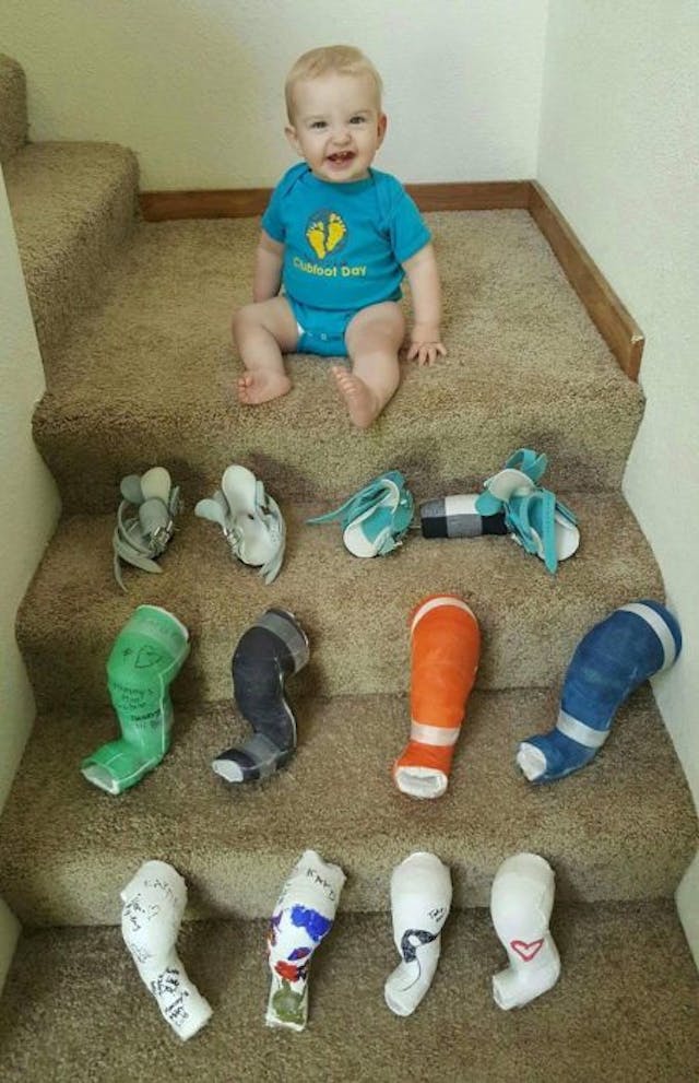 Silas and his casts Babies like Silas, diagnosed with treatable conditions, are aborted every day. They deserve a chance at life. image