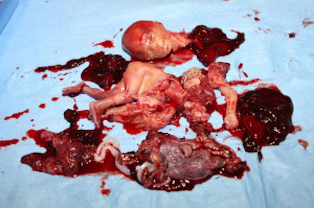 It’s not fun to talk about, but this is abortion. More real abortions are shown here. It's not fun to talk about, but this is abortion.