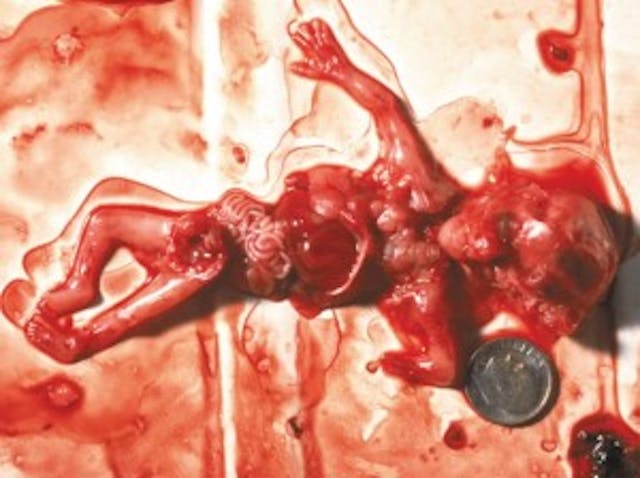 A 10 week abortion (from abortionno.com) So is this. A 10 week abortion (from abortionno.com)
