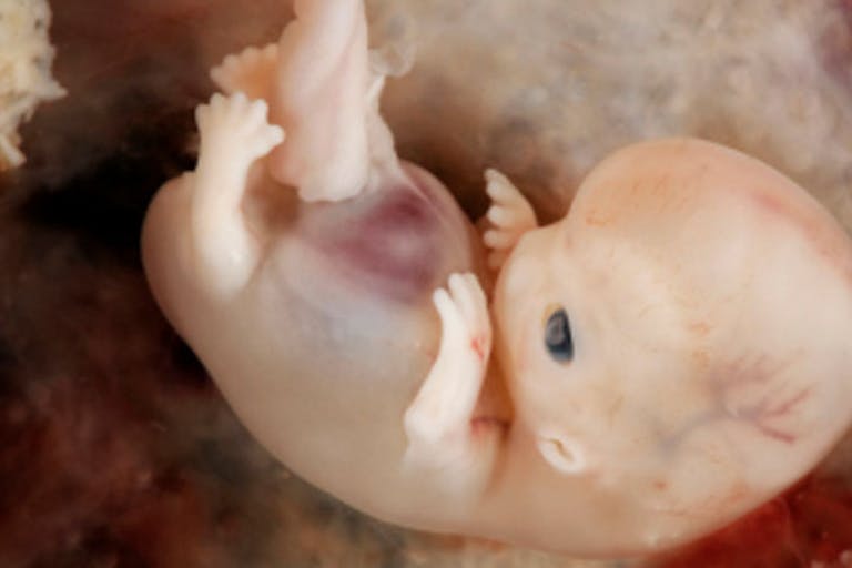 abortion, baby 8 weeks, pregnancy