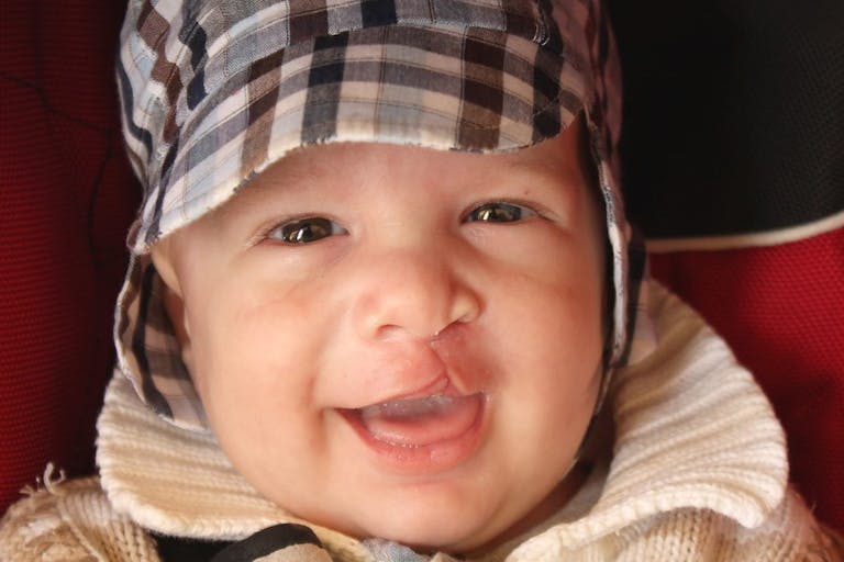 cleft lip
