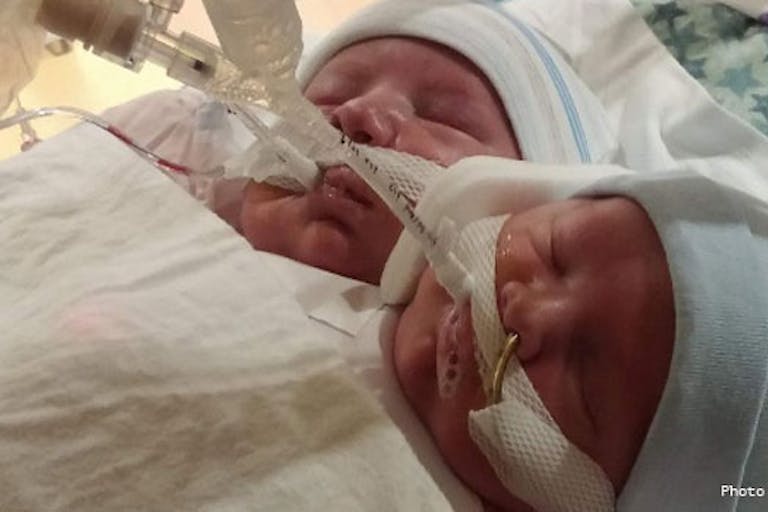 kroeger-conjoined-twins-elijah-isaac