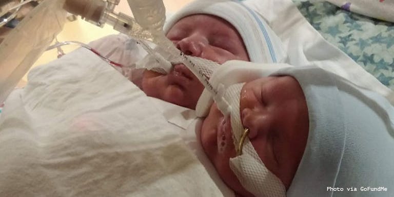 kroeger-conjoined-twins-elijah-isaac