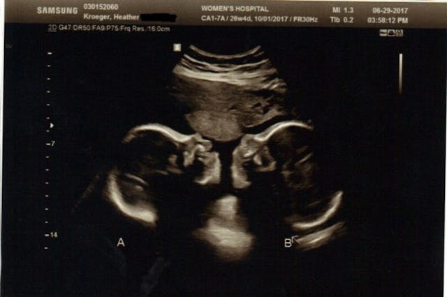 Amazing: Conjoined twins saved from abortion are now ‘thriving’ image