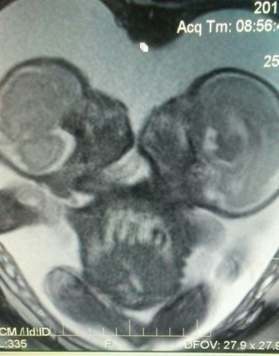 Amazing: Conjoined twins saved from abortion are now ‘thriving’ image