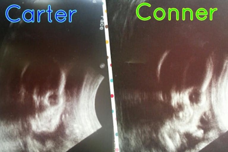 carter-conner-ultrasound