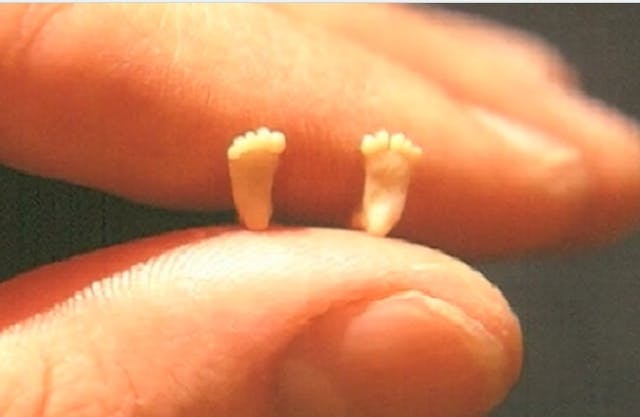 Dr. Sacco’s picture of aborted baby feet How one photo of a preborn baby helped to make future generations pro-life image