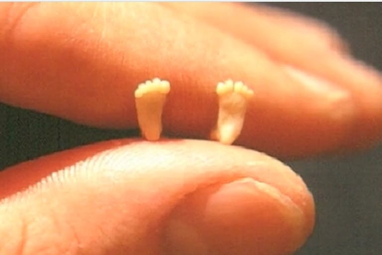 Dr. Sacco’s picture of aborted baby feet How one photo of a preborn baby helped to make future generations pro-life image