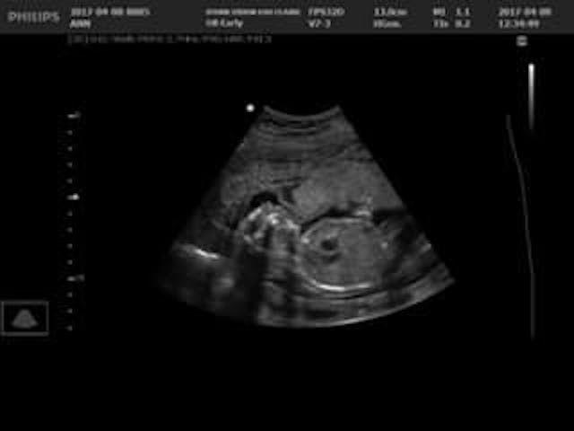 20 week ultrasound of Miriam (Photo courtesy of the Mahner family) 20 week ultrasound of Miriam Grace who had anencephaly
