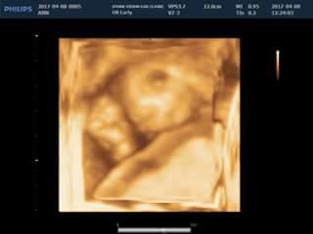 18 week ultrasound of Miriam. (Photo courtesy of the Mahner family) Baby Miriam’s story is showing the world that even short lives are worth living image
